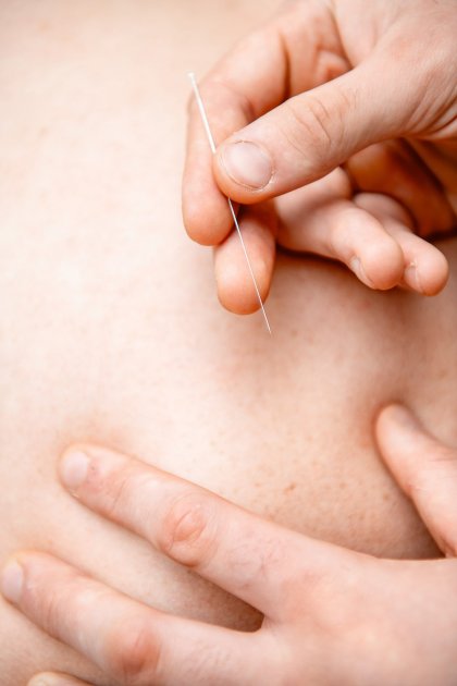 Голкорефлексотерапія